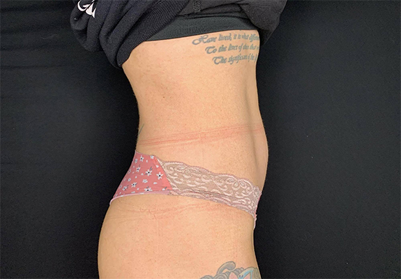 Abdomen after CLATUU fat freezing