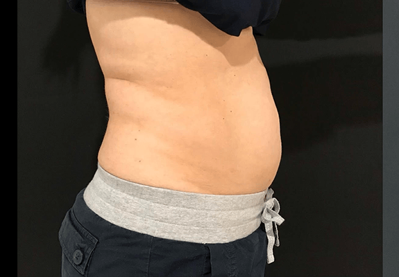 Abdomen before CLATUU fat freezing