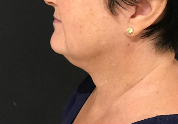Double chin after CLATUU fat freezing