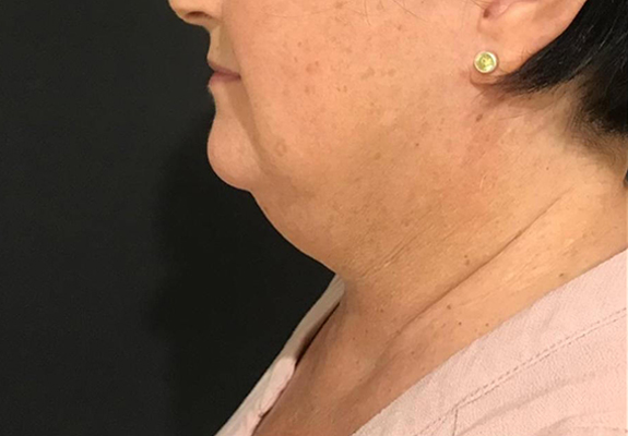 Double chin before CLATUU fat freezing