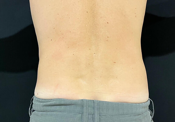 Love handles after CLATUU fat freezing